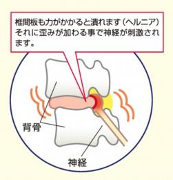 椎間板ヘルニア